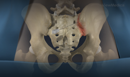 Sacroiliac Joint Injection