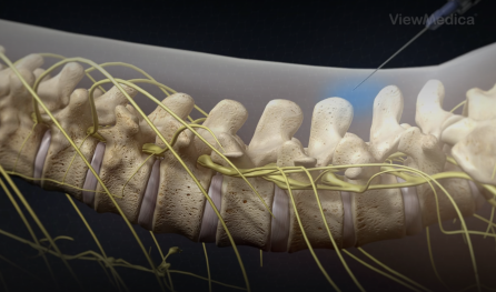 Lumbar Epidural Steroid Injection