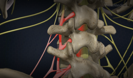 Transforaminal Epidural Steroid Injection