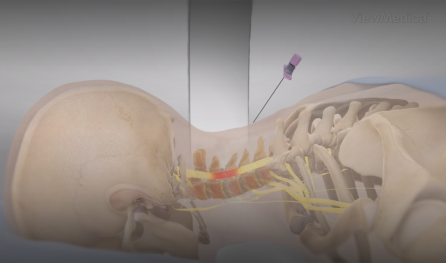 Cervical Epidural Steroid Injection