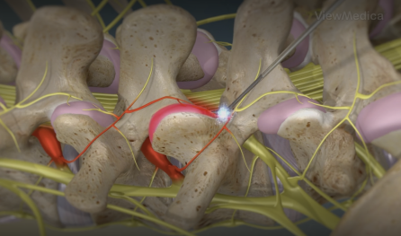 Radiofrequency Ablation