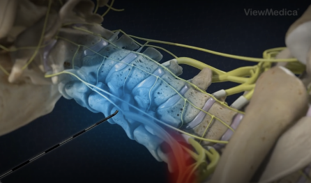 Epidural Steroid Injection