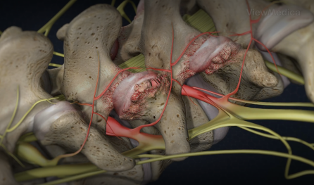 Facet Joint Injection