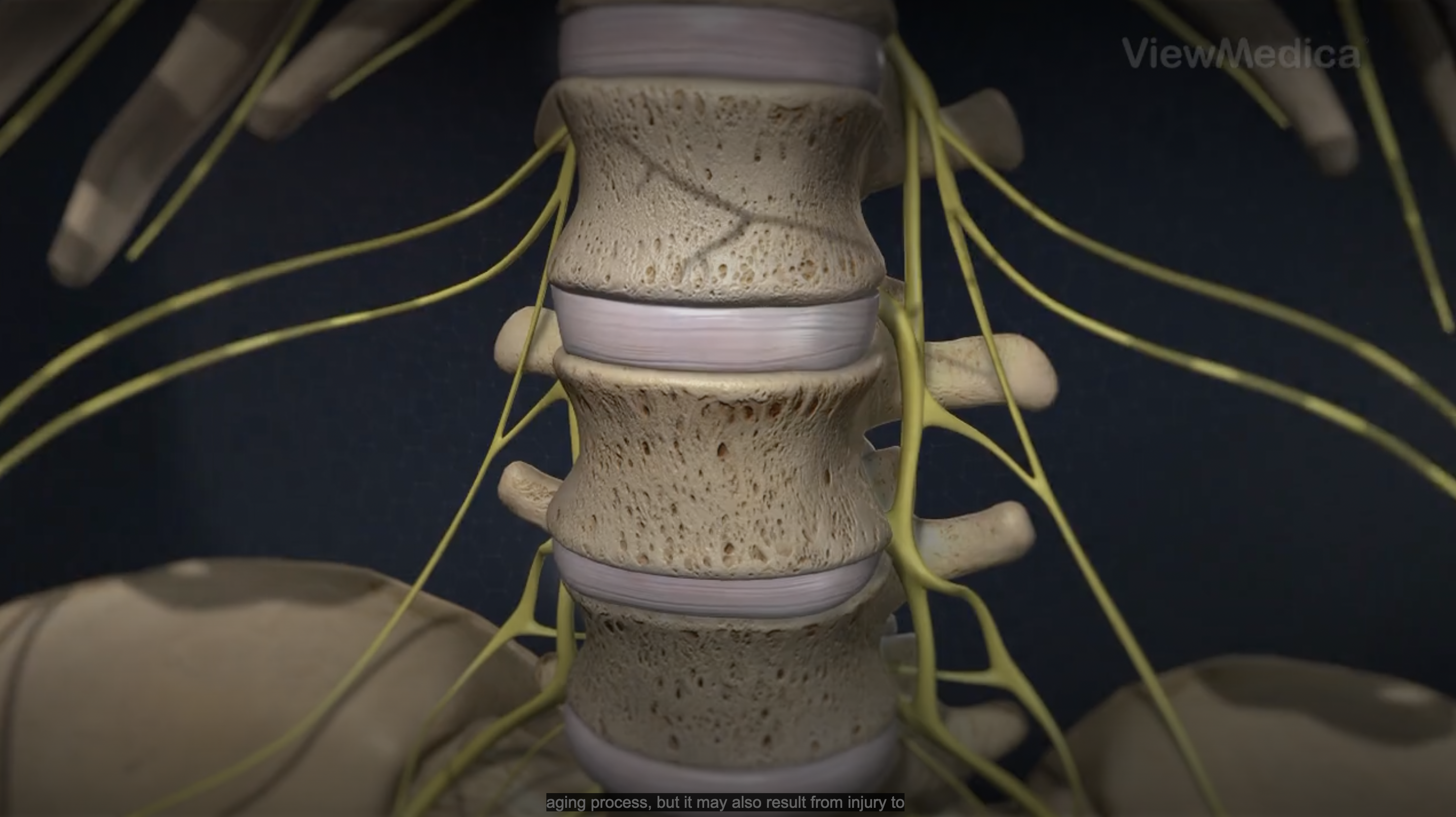 Disc Degeneration Thumb