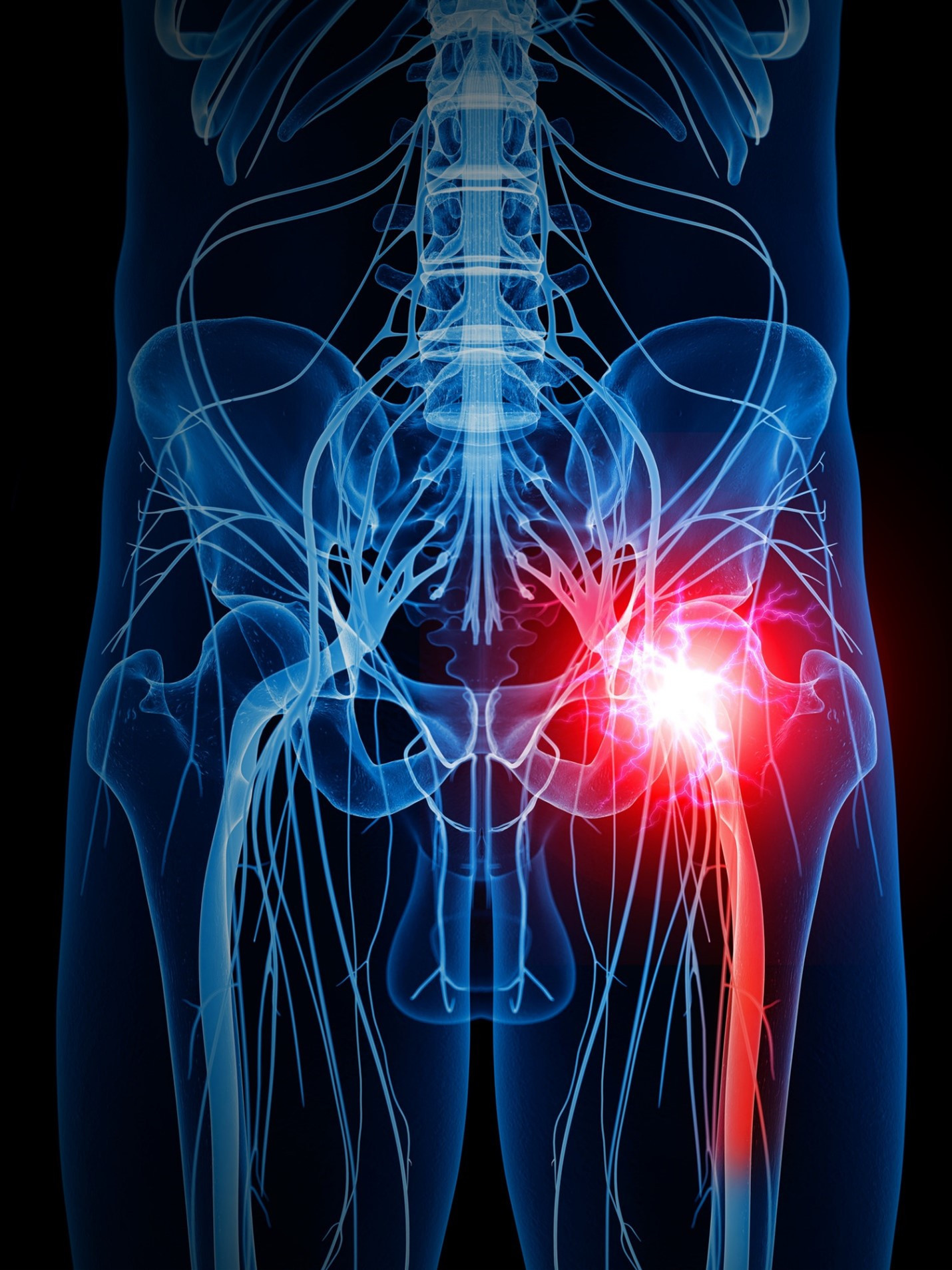 Sciatica pain illustration